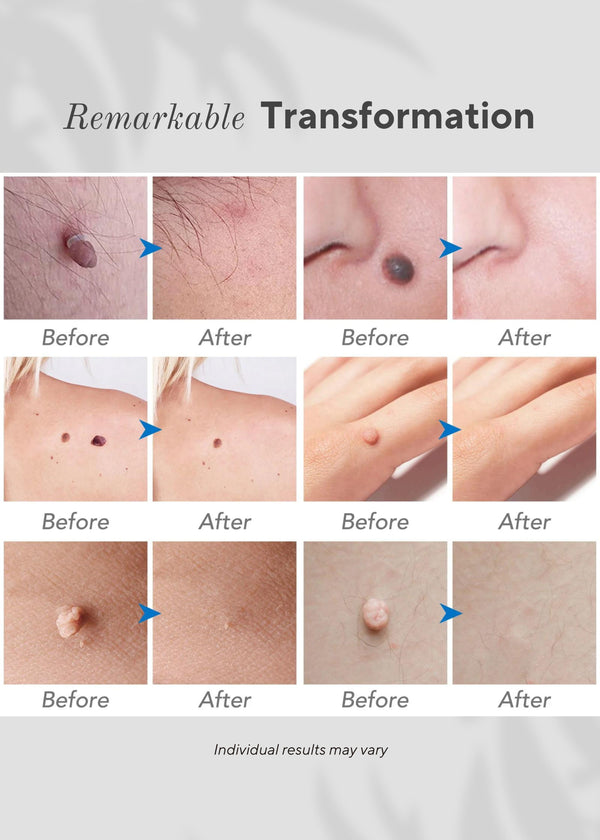 🍪 6-in-1 Skin Imperfection Removal Pen