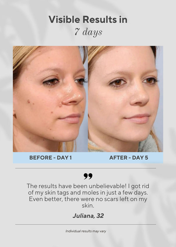 🍪 6-in-1 Skin Imperfection Removal Pen